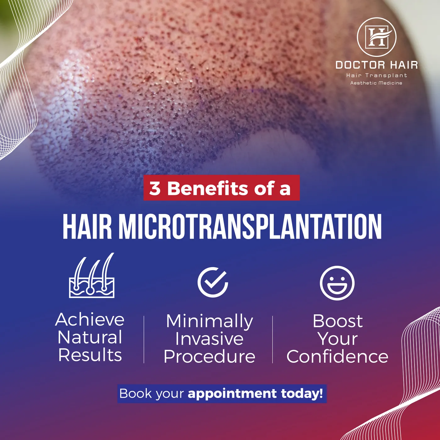 Dr.Hair — Post: beneficios del microtrasplante